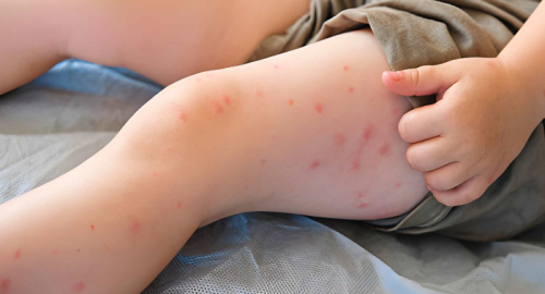 Morbillo in aumento, il ritorno di una malattia prevenibile svela la fragilit� dei programmi vaccinali